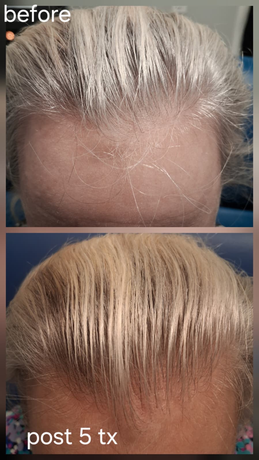 Hair restoration result